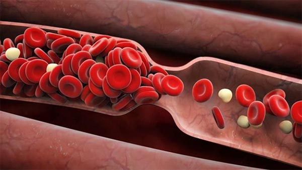 Sức khỏe, đời sống: Nguyên nhân và giải pháp cho bệnh lý lưu thông máu kém Anh-1